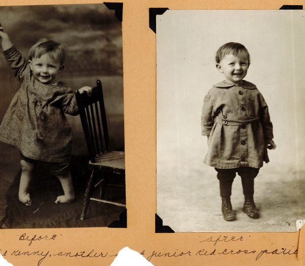 A “before and after” image of “Kenny” whose treatment for club feet was paid for by the Junior Red Cross “Crippled Children’s Fund,” ca. 1920s-1930s