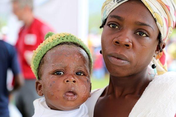 Young patient with chicken pox and his mother at a Red Cross mobile clinic